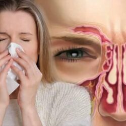 Burun Tıkanıklığı Burun Tıkanıklığı