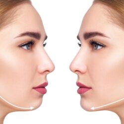 Çene Dolgusu Çene Dolgusu